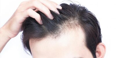 Mơ thấy hói đầu đánh con gì?
